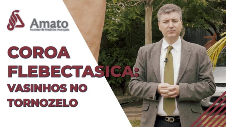 Vasinhos no tornozelo: Coroa flebectasica!